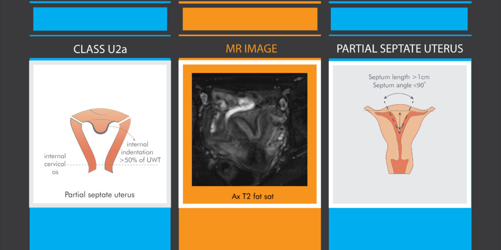 Fig.1-MRI-comparison-of-partial-septate-uterus-according-to-both-classifications-Illustrations-MJ-design