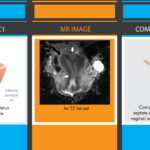 Fig.3-MRI-comparison-of-complete-septate-uterus-according-to-both-classifications-Illustrations-MJ-design