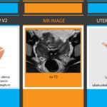 Fig.4-MRI-comparison-of-bicorporeal-and-didelphys-uterus-according-to-both-classifications-Illustrations-MJ-design