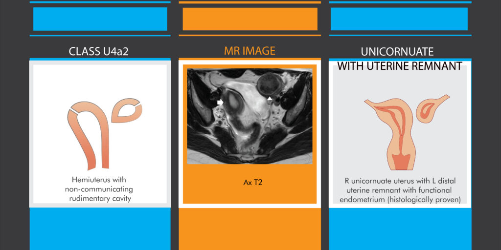 Fig.6-MRI-comparison-of-hemiuterus-and-unicornuate-uterus-with-remnant-according-to-both-classifications-Illustrations-MJ-design
