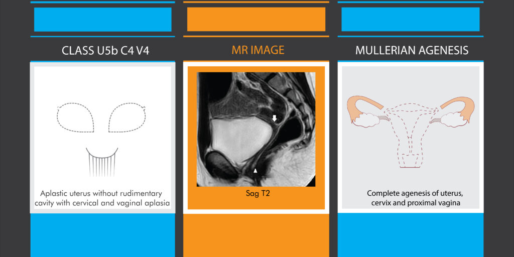 Fig.7-MRI-comparison-of-aplastic-uterus-and-uterine-agenesis-according-to-both-classifications-Illustrations-MJ-design