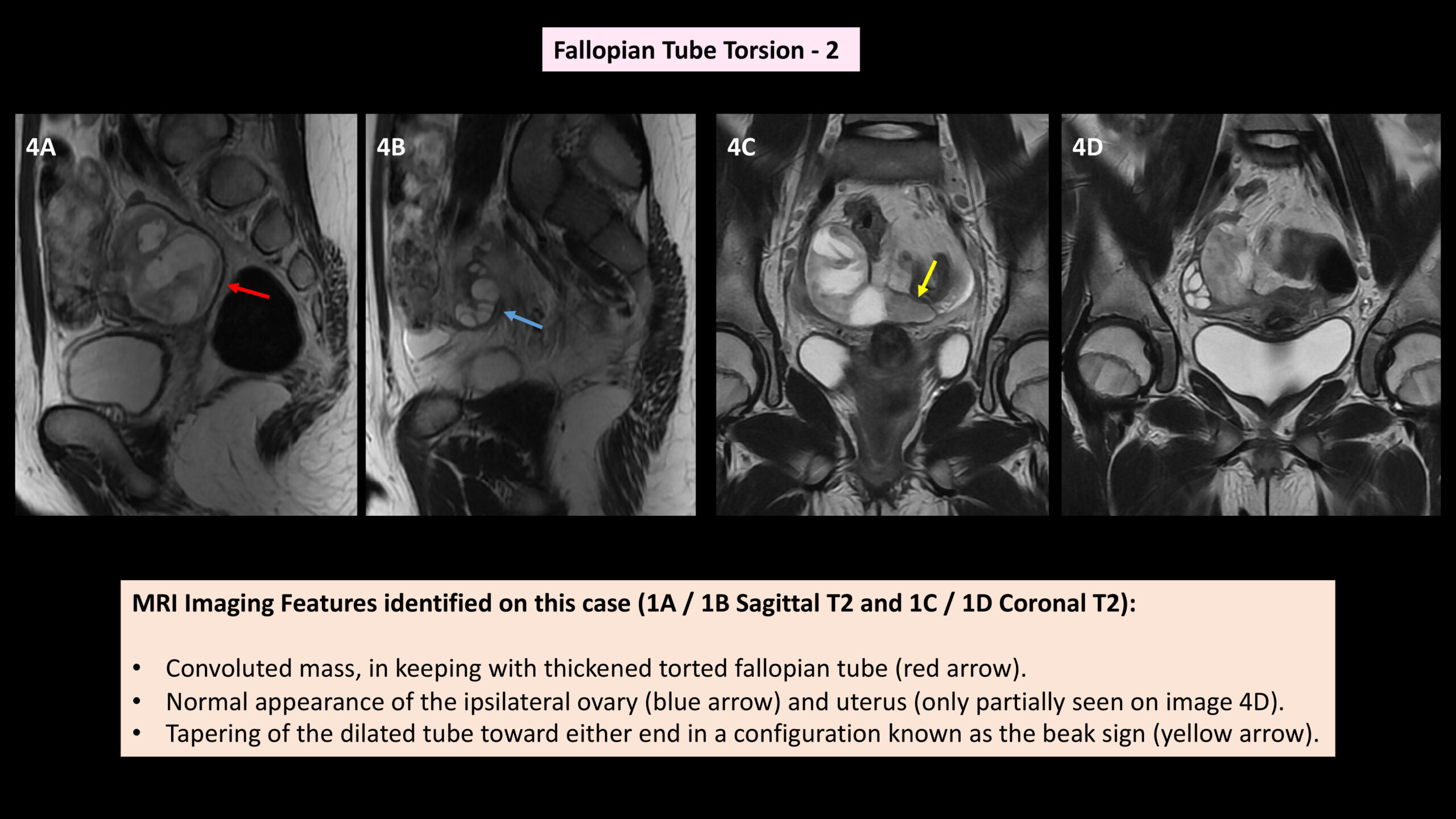 Untangling the Mystery: Radiological Insights into Female Pelvic Organ Torsion