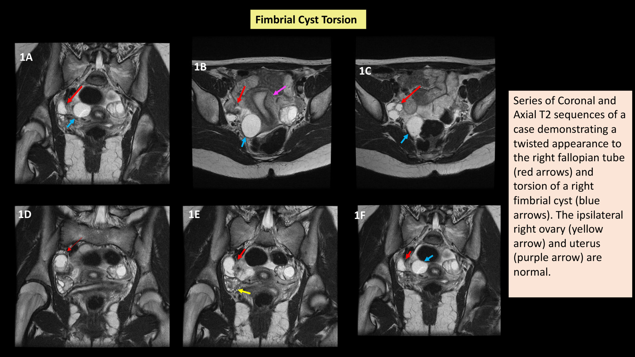 Untangling the Mystery: Radiological Insights into Female Pelvic Organ Torsion