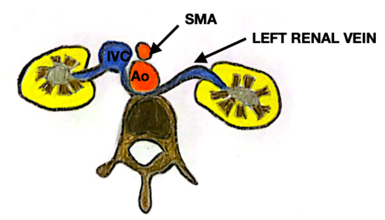 Retro-aortic-left-renal-vein